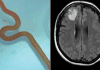 دنیا میں پہلی بار انسان کے دماغ میں زندہ کیڑا دریافت